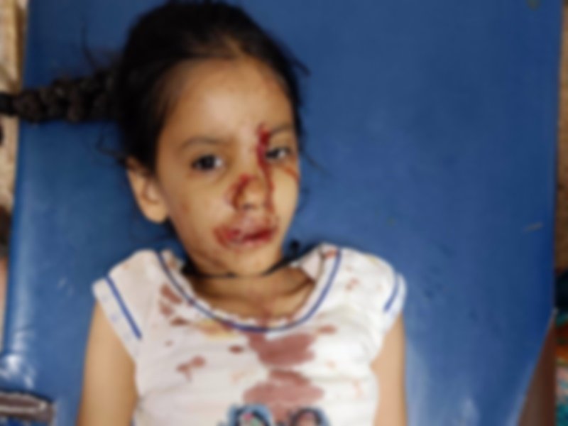 इंदौर में आवार श्वानों का आतंक, सात बच्चों काे आवारा श्वान ने काटा