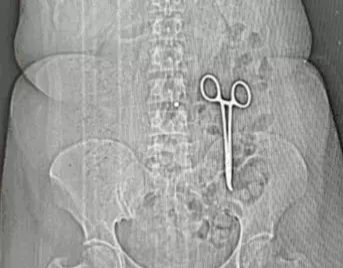 महिला के पेट में दो साल बाद निकली कैंची:ग्वालियर के अस्पताल में कराया था ऑपरेशन; पीड़ित बोलीं-असहनीय दर्द झेला