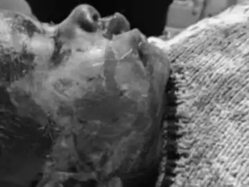 कुत्तों ने 18 जगह काटा, 107 टांके आए