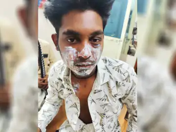 भोपाल के एसिड अटैक केस का खुलासा:पटाखे से झुलसा था युवक