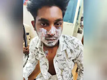 भोपाल में युवक पर एसिड अटैक