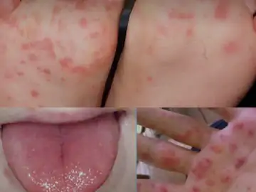 बच्चों को फिर जकड़ रहा टोमैटो फ्लू