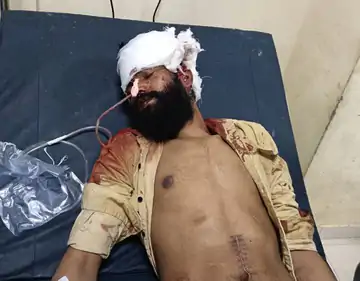 भोपाल: पुराने केस में समझौते से इनकार पर युवक का कान काटा, हालत नाजुक