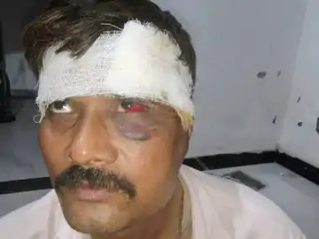 ई-अटेंडेंस की जल्दबाजी में शिक्षक का एक्सीडेंट: रामपुर घाटी में फिसली बाइक, आंख में चोट